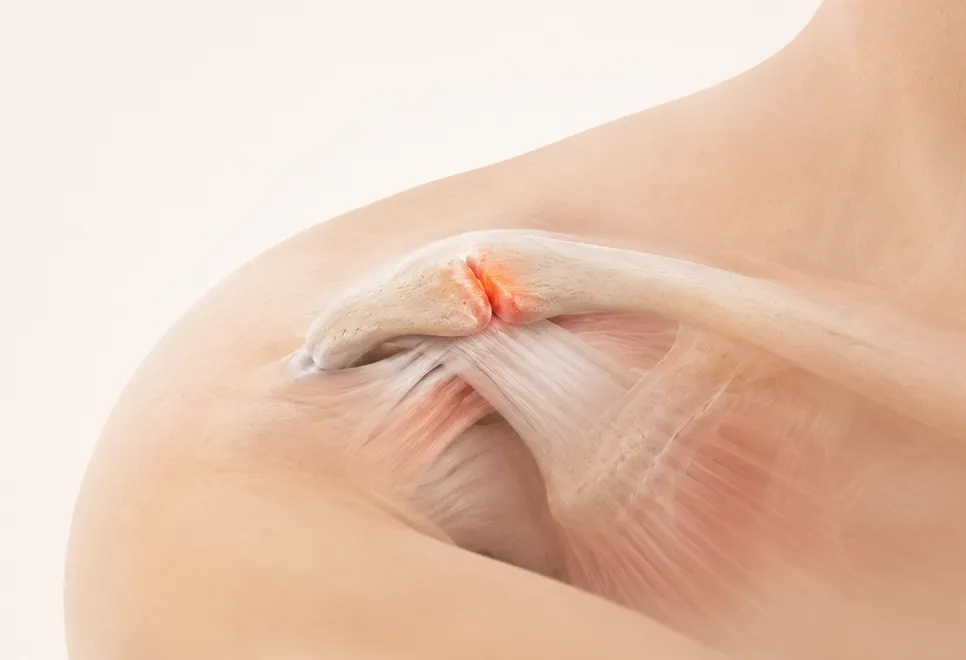 Sobrecarga da articulação acromioclavicular (ilustração)