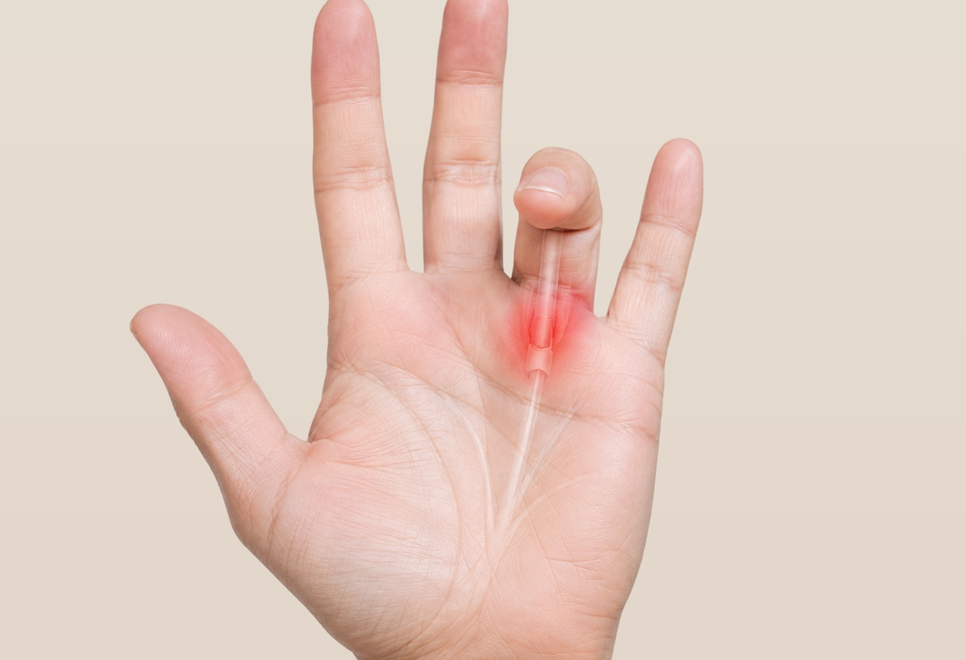 Dedo em gatilho — tendão flexor travando na polia (ilustração)